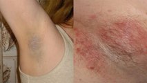 Underarms में Fungal Infection क्यों होता है । Underarms में Fungal Infection होने का कारण । *Health