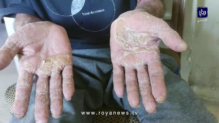 مرض جلدي "غريب" يفتك بالستيني أبو محمد