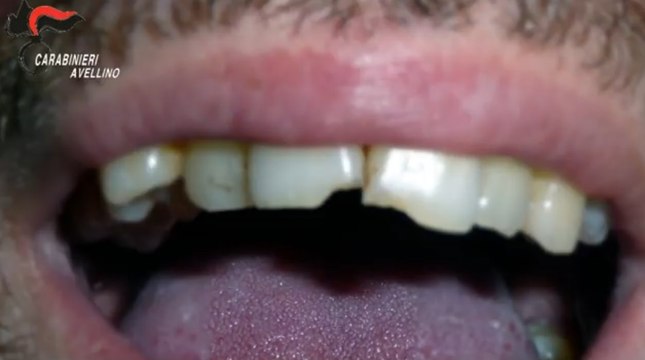 Avellino, truffe assicurative con falsi incidenti stradali: 11 arresti e centinaia di indagati. Si facevano rompere anche denti e arti (22.06.22)