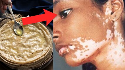 घी रोटी खाने के बाद 1 चीज से सफेद दाग का खतरा MUST WATCH | Boldsky *Health