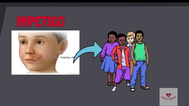 Impetigo skin infection (crusty sores): Causes, Symptoms & Treatment