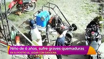 Menor sufre quemaduras de tercer grado en el rostro tras jugar con gasolina