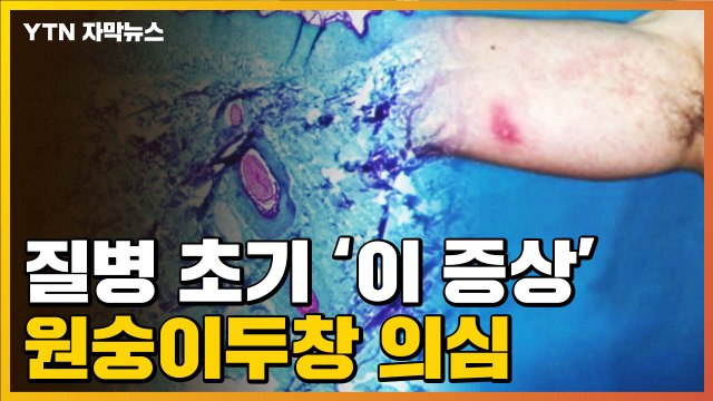 [자막뉴스] 질병 초기 '이 증상' 나타나면...원숭이두창 의심 / YTN