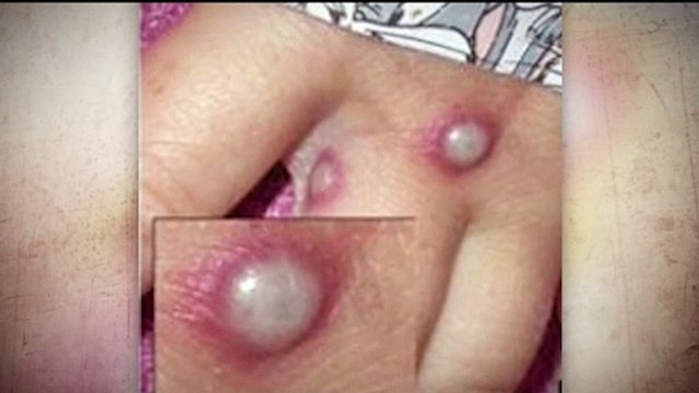 5 casos de la viruela del simio en Colorado