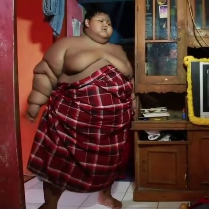 Over weight surgery and cure of a child