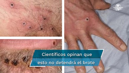 OMS podría declarar "emergencia global" por viruela del mono