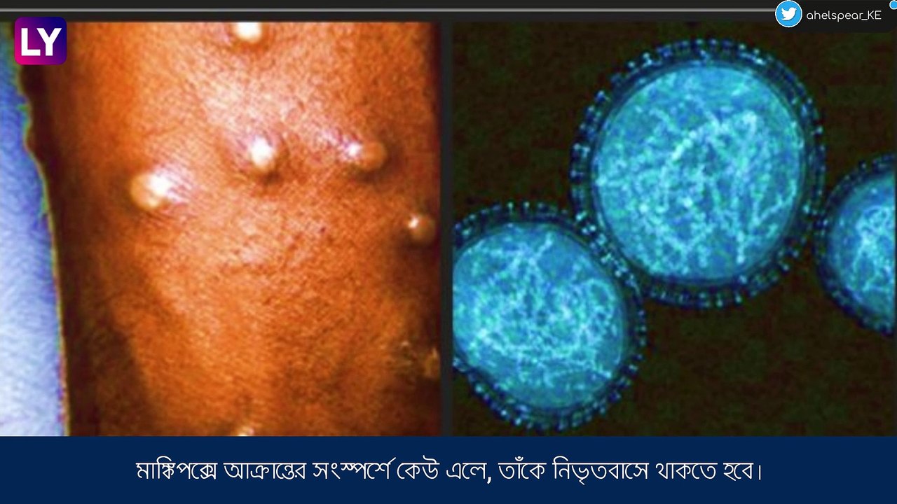 Monkeypox নিয়ে আতঙ্ক, ভাইরাস থেকে রক্ষা পাওয়ার কৌশল দেখুন