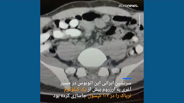 تصاویر معده یک مسافر ایرانی در ترکیه که ۱۰۲ کپسول‌ حاوی تریاک را قورت داده بود
