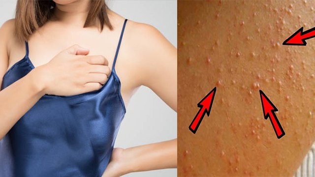 Chicken Skin Problem क्या है | Chicken Skin Problem Symptoms जानकर चौंक जाएंगे |Boldsky *Health