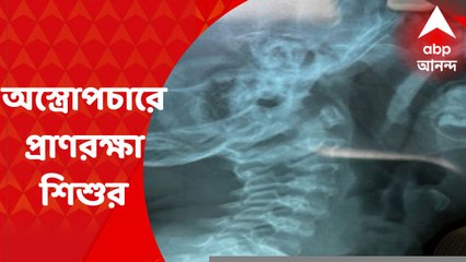 SSKM : এসএসকেএমে জটিল অস্ত্রোপচার, দেড় বছরের শিশুর গলা থেকে বের হল দারুচিনি