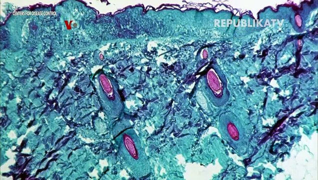 Stigmatisasi Pengidap Cacar Monyet Dinilai Hambat Pengendalian Perebakan