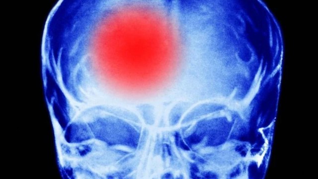 AVC : comment reconnaître les signes avant-coureurs