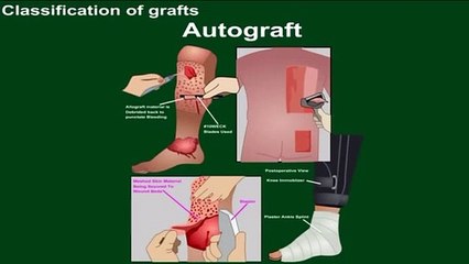 Comprehensive Guide to Graft Classification 🩺