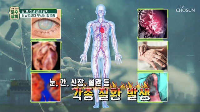 초기에는 증상이 없어 더욱 무서운 당뇨 합병증 TV CHOSUN 20220629 방송