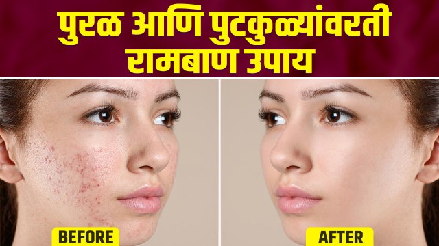 बारीक पुरळांनी चेहरा भरलाय का? करा हा उपाय | Home remedies for tiny bumps