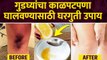 कोपर, गुडघे यांचा काळेपणा घालविण्यासाठी उपाय | How To Lighten Dark Knees & Elbows | Dark Knees