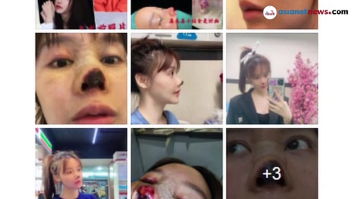 സുന്ദരിയാകാൻ മൂക്കിൽ ശസ്ത്രക്രിയ; ഒടുവിൽ മൂക്കിൻ തുമ്പിലെ കോശങ്ങൾ 'മരിച്ചു'