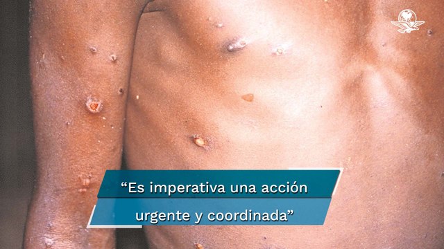 Viruela del mono. OMS pide respuesta urgente de Europa ante aumento de casos