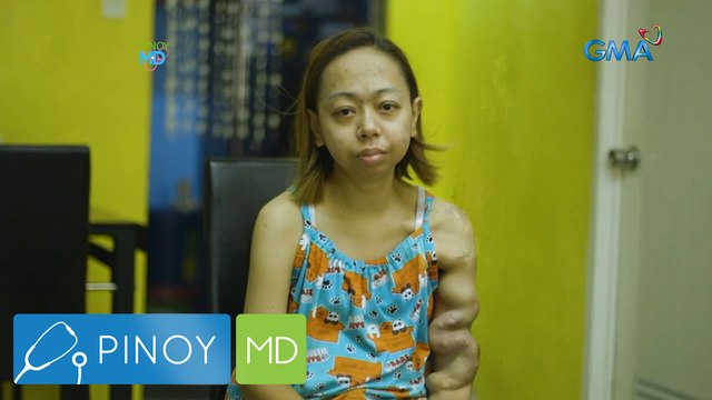 Ugat sa braso ng isang babae, bakit biglang namaga at kumulubot? | Pinoy MD