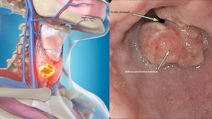 खाना खाते समय निगलने में होती है दिक्कत, Oesophageal Cancer Symptoms होने के संकेत | Boldsky *Health