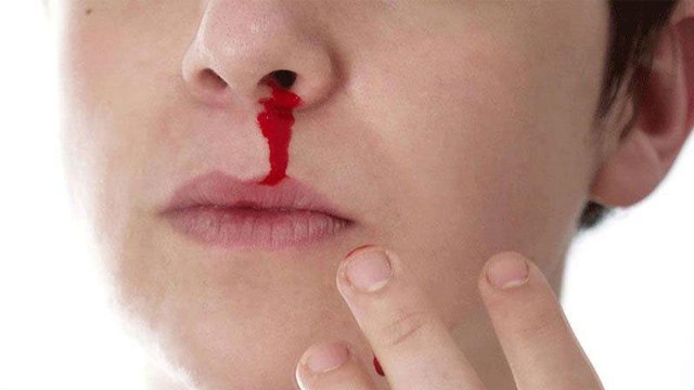 Nose Bleed Fever: इस बुखार में नाक से बहता है खून | नाक से खून क्यों निकलता है | Boldsky *Health