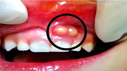 दांत में फोड़ा होना का कारण । दांत में फोड़ा कैसे होता है । Boldsky *Health