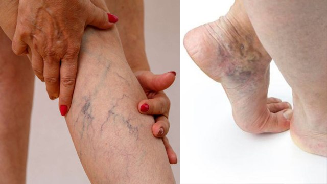 High Cholesterol के पैरों में होते हैं ये लक्षण | High Cholesterol Symptoms in Legs| Boldsky *Health