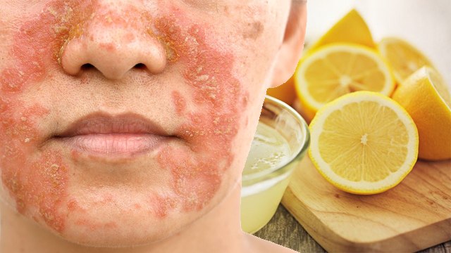 Face पर Lemon लगाने से क्या होता है | चेहरे पर नींबू लगाने से क्या होता है | Boldsky *Health