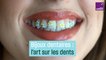 Les bijoux dentaires ou la créativité sur les dents