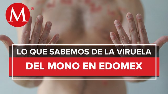 Edomex reporta primeros dos casos de viruela del mono