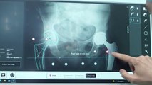 Humanitas, per le protesi d'anca un navigatore computerizzato