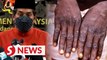 Khairy: 14 casual contacts identified from M’sian infected with monkeypox in Singapore