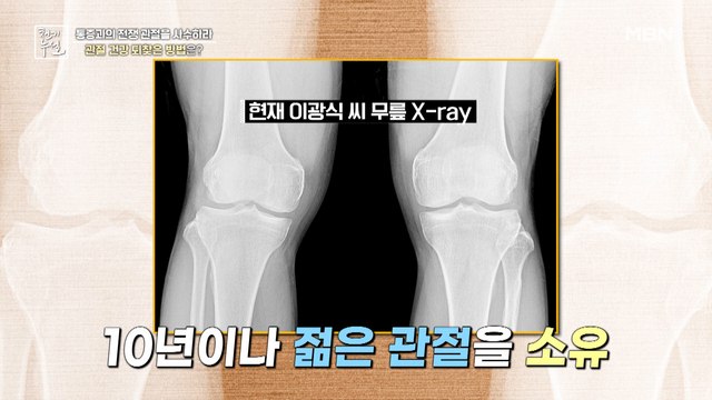 10년이나 젊은 관절 소유! 관절 건강 되찾은 특별한 비법의 정체는?