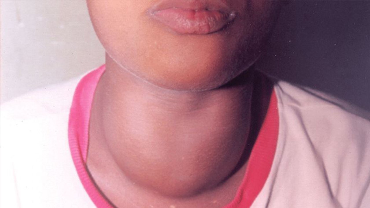 Thyroid Swelling Treatment: थायराइड में सूजन ठीक करने का जबरदस्त उपाय | Boldsky *Health