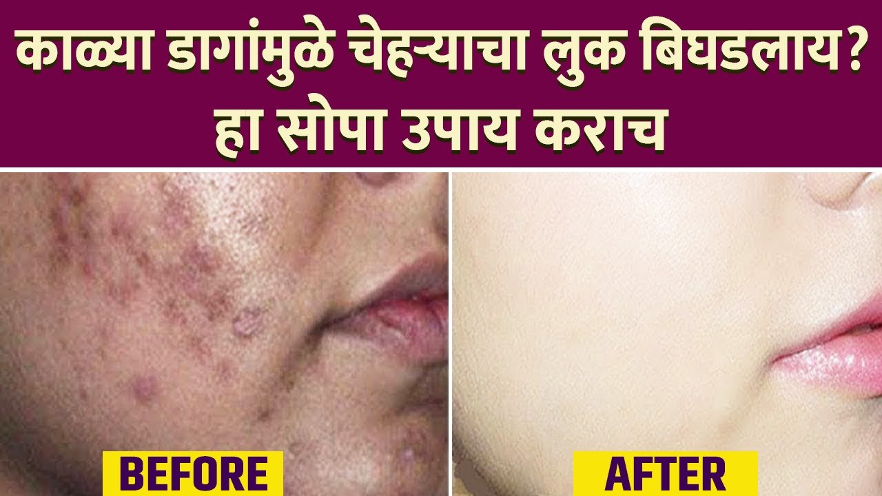 काळ्या डागांवर घरगुती उपाय| | How To get Rid Da...
