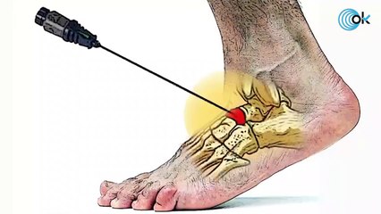 Así será la recuperación de Nadal tras su lesión en Wimbledon