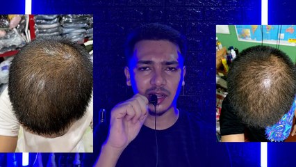 Dutasteride 2-Month Results: Before & After Review 💊