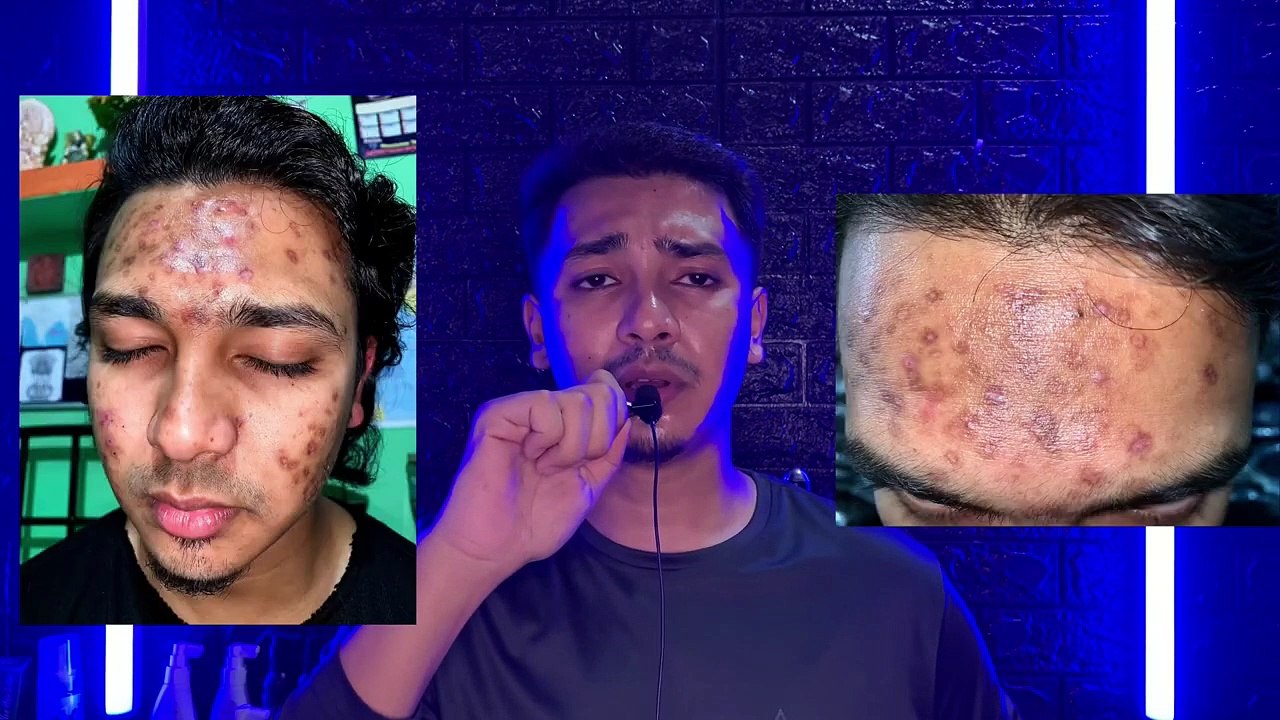 Minoxidil 10% 4 Months Review Minoxidil 10 Percent Result Mintop Minoxidil 10% Hair Before After