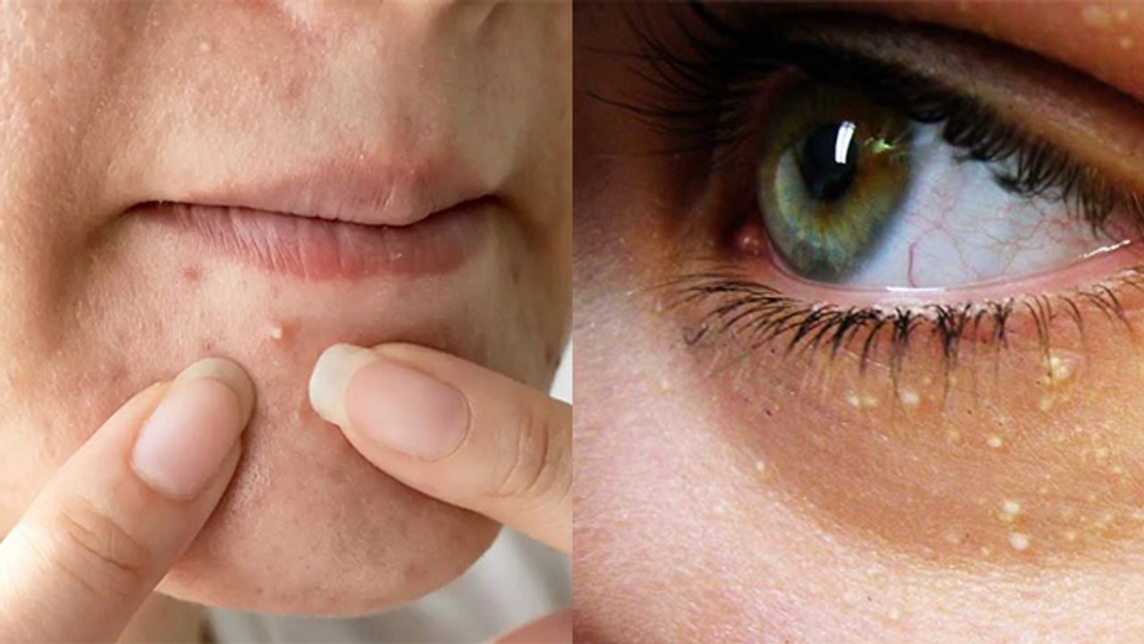 Milia White head में Difference क्या है, Face पर दिखने वाले सफेद दाने का कारण | Boldsky *Beauty