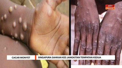 Cacar Monyet | Singapura sahkan kes jangkitan tempatan kedua