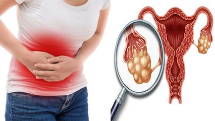 Katrina Kaif को Chocolate Cyst जैसी गंभीर बीमारी, जानिए Symptoms और Reason । Boldsky *Health