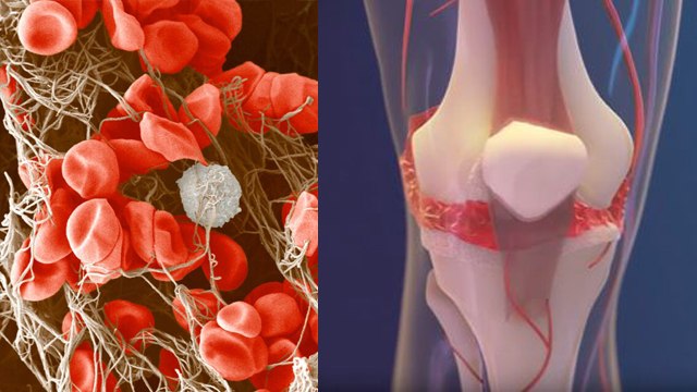 Bleeding Disorder होना खतरनाक,जानें कारण लक्षण और इलाज । Boldsky *Health