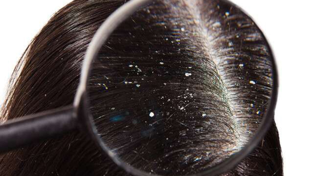 Dandruff kis Vitamin ki kami se hota hai | डैंड्रफ किस विटामिन की कमी से होता है | Boldsky*Health