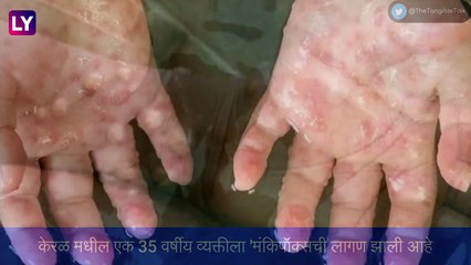 Monkeypox in India: देशात \'मंकिपॉक्स\'चा पहिला रूग्ण आढळला, प्रकृती स्थिर असल्याची माहिती