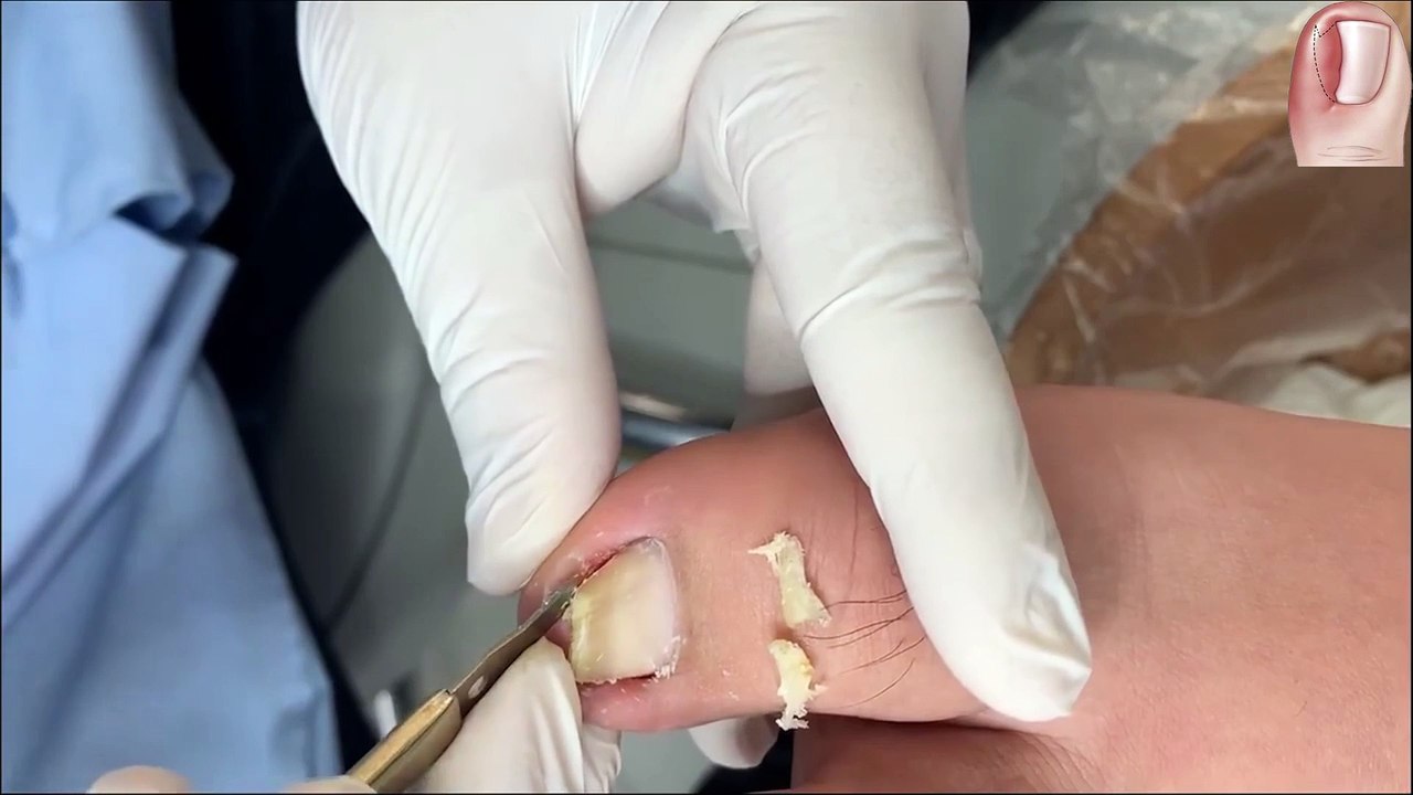 HOW TO CUT THICK TOENAILS - Toenail Cleaning Satisfying #8