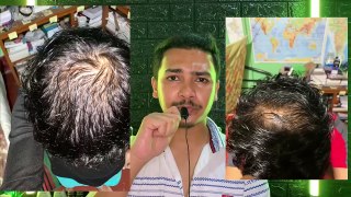 Can You Use Minoxidil & Redensyl Together Can You Use Redensyl While Using Minoxidil Routine