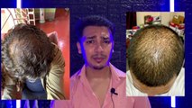 Dermaroller Hair Before After 3 Month Review Dermaroller Results 90 Days 90 Photos Hair Grow