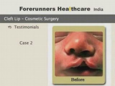 low cost cleft lip surgery in india