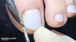 HOW TO CUT THICK TOENAILS - Toenail Cleaning Satisfying #17