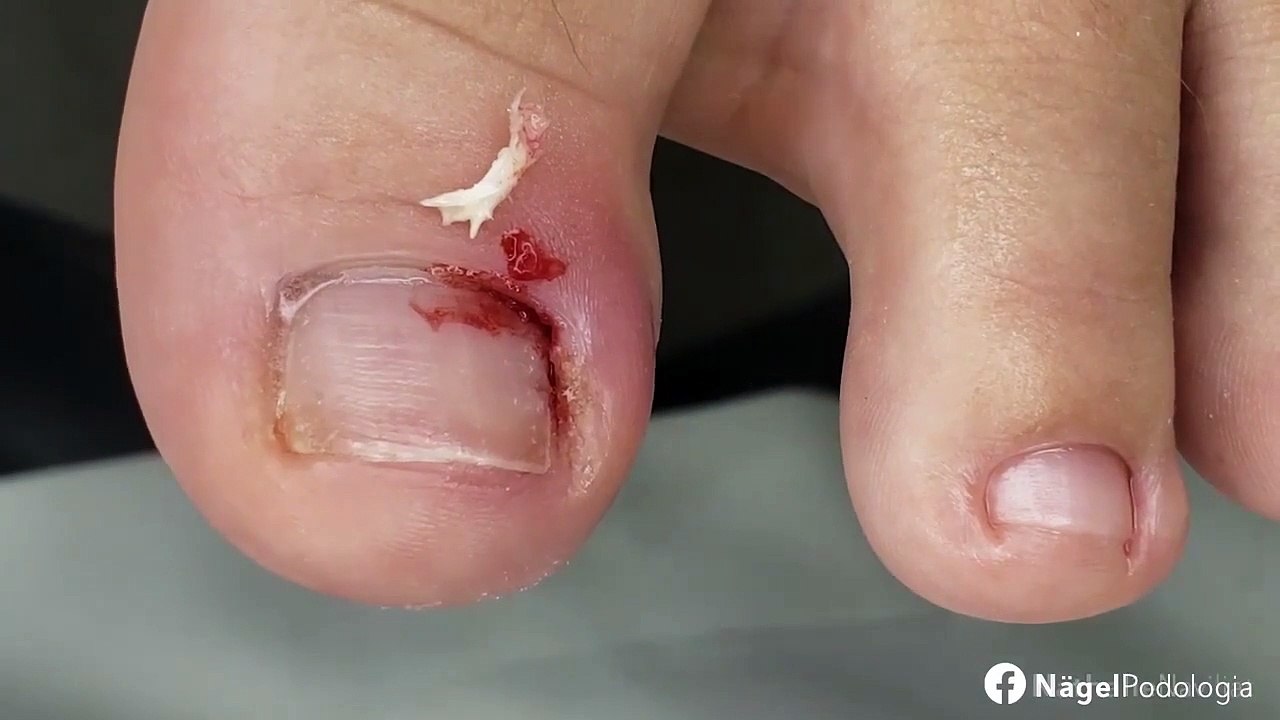 HOW TO CUT THICK TOENAILS - Toenail Cleaning Satisfying #20